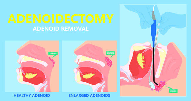 Ketahui Apa Itu Adenoidektomi - Alodokter