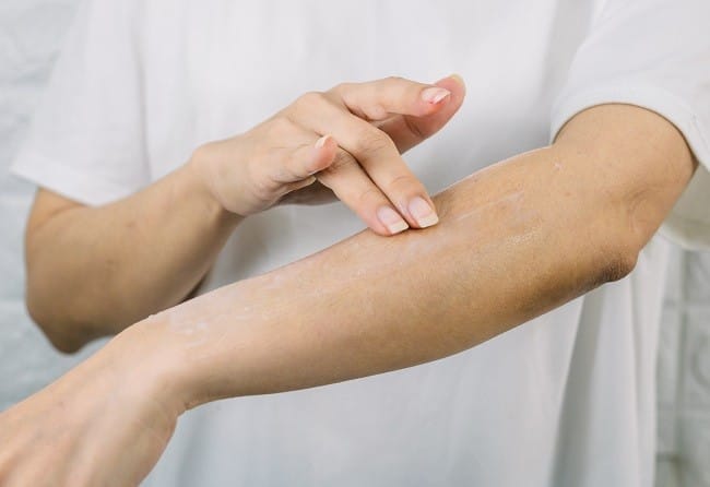 Hidrokortison - Alodokter