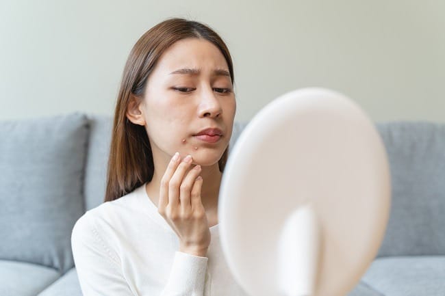 12 Obat Jerawat untuk Usir Jerawat Membandel - Alodokter