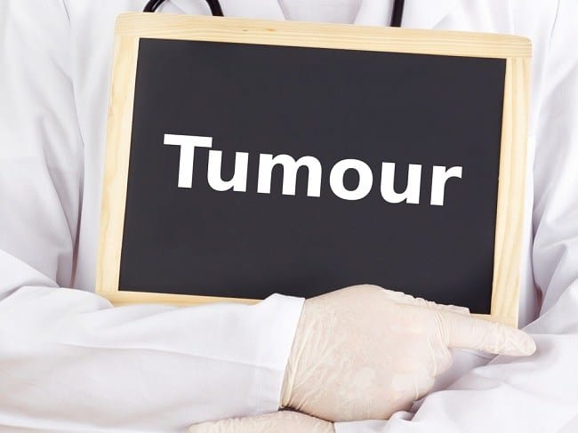 Beberapa Penanganan dan Obat Tumor yang Umum Digunakan - Alodokter