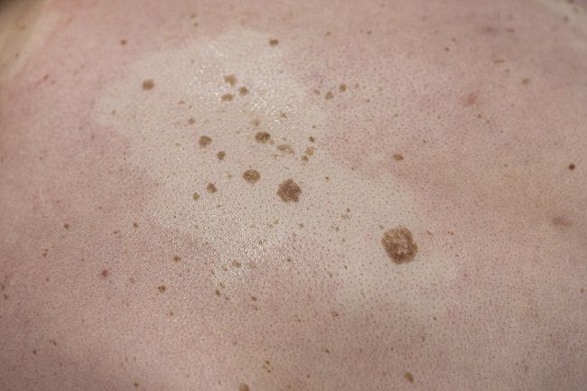 Keratosis Seboroik - Alodokter