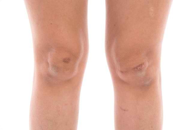 7 Cara Menghilangkan Koreng yang Berbekas - Alodokter