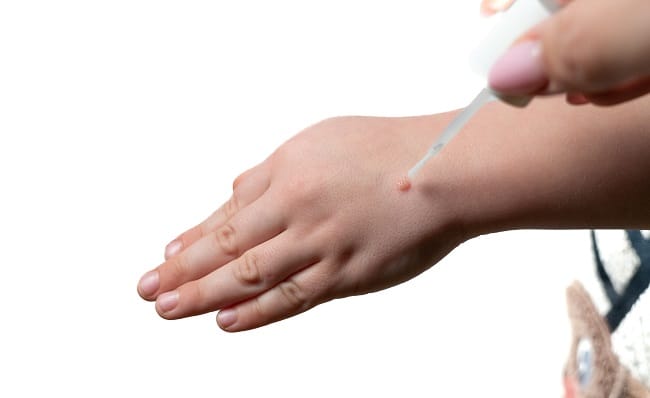 5 Obat Kutil yang Ampuh - Alodokter