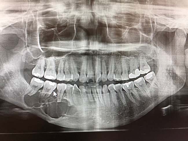 Ameloblastoma - Alodokter