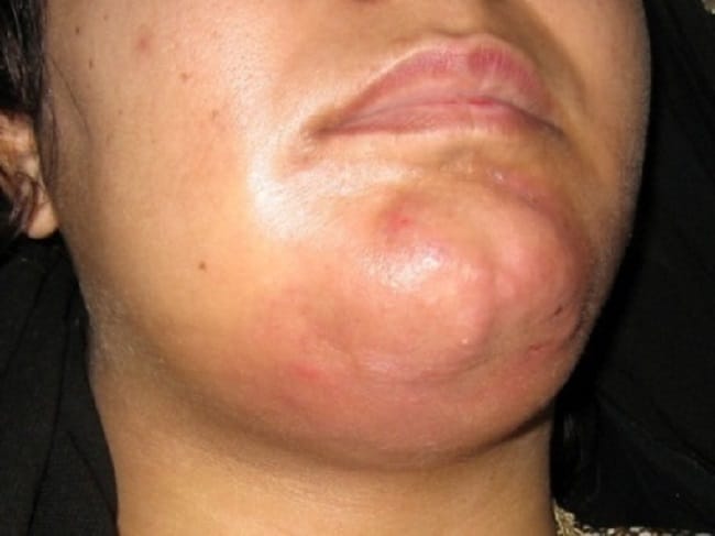 Angina Ludwig - Alodokter