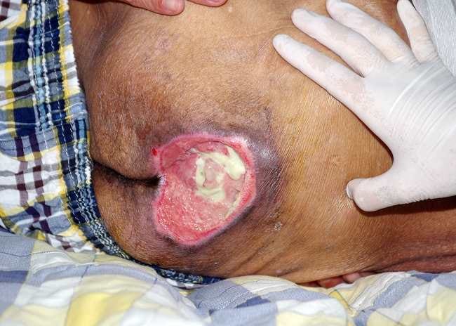 Ulkus Dekubitus - Alodokter