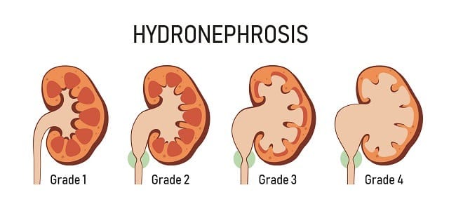 Hidronefrosis - Alodokter