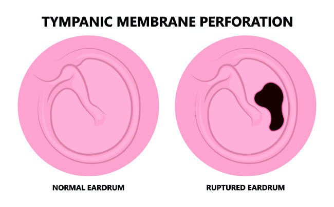 Gendang Telinga Pecah - Alodokter