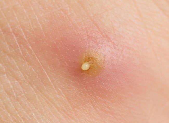 10 Obat Bisul Ampuh yang Bisa Dibeli di Apotik - Alodokter