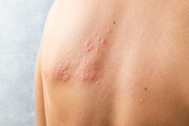 Penyebab Herpes dan Cara Mencegahnya - Alodokter