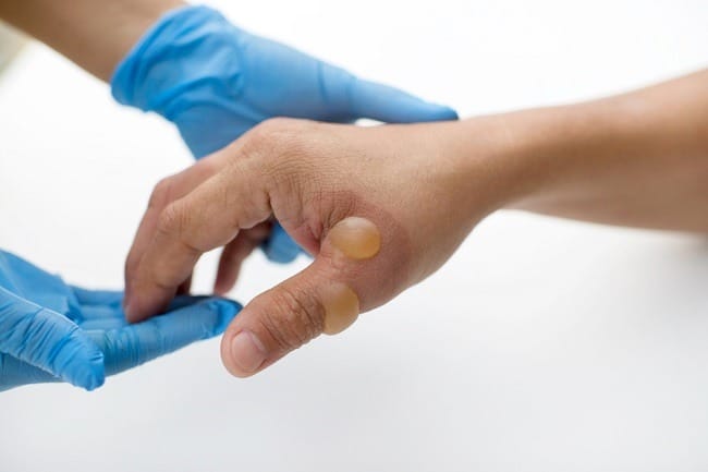 5 Obat Kena Air Panas agar Luka Tidak Makin Parah - Alodokter