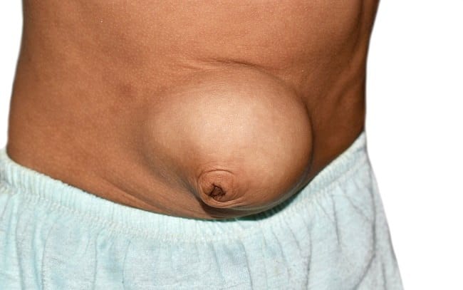 Hernia Umbilikalis - Alodokter