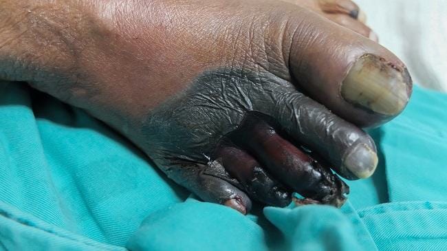 Gangrene - Alodokter