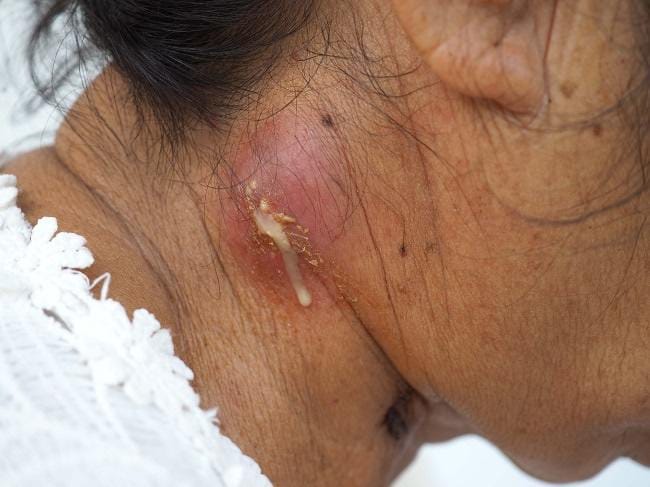 Skrofuloderma - Alodokter