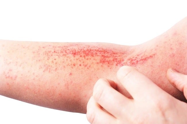 Stasis Dermatitis, Ketahui Penyebab, Gejala, dan Pengobatannya - Alodokter