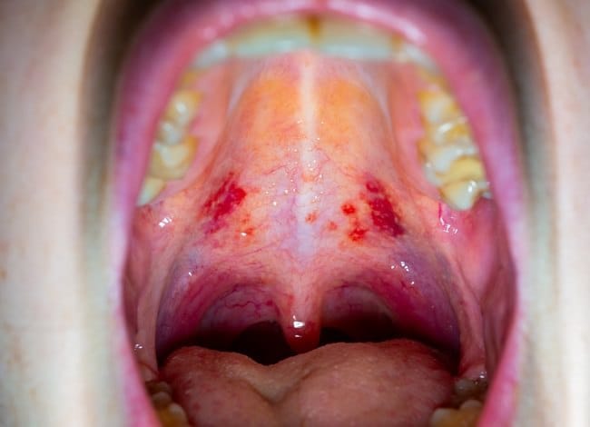 Langit-langit Mulut Sakit, Kenali Penyebab hingga Pencegahannya - Alodokter