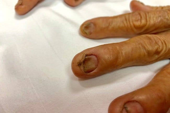 Koilonychia, Kenali Penyebab dan Pencegahannya - Alodokter