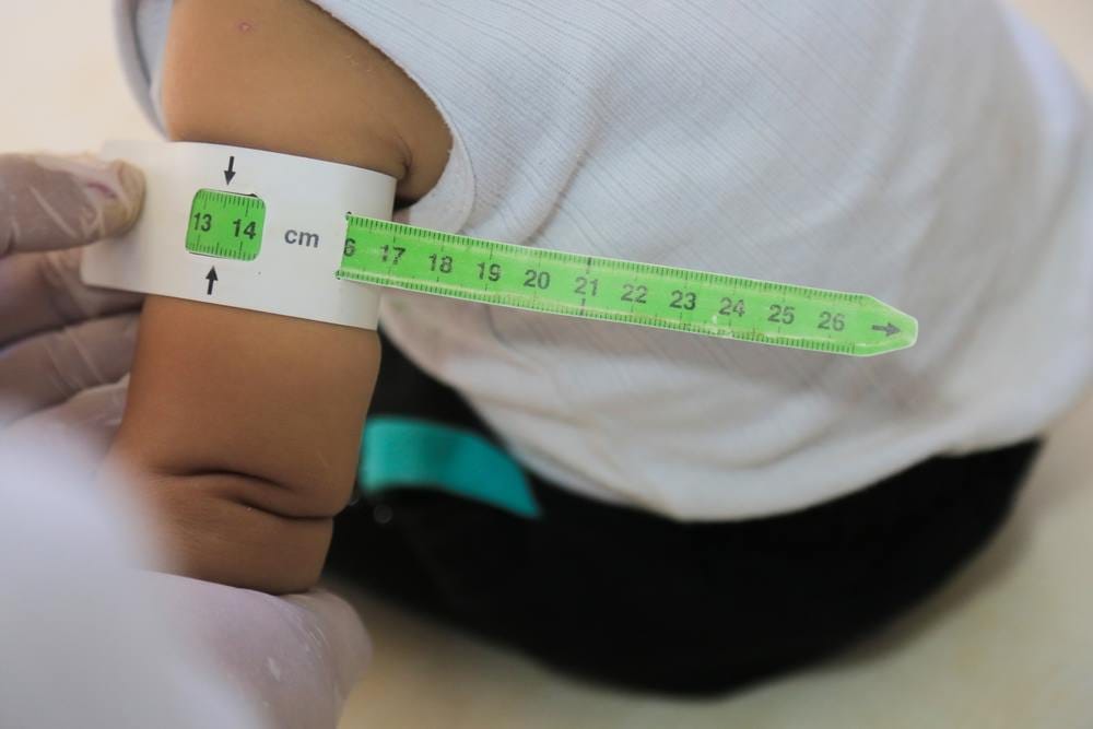 RUTF, Makanan Khusus untuk Balita Gizi Buruk - Alodokter