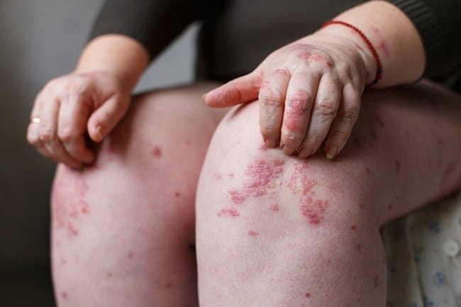 Psoriasis Gutata, Ketahui Penyebab dan Pengobatannya - Alodokter