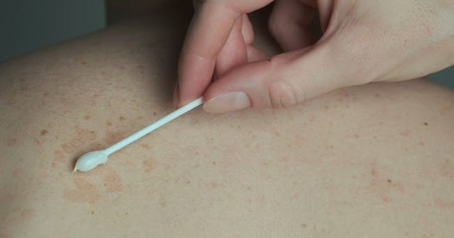6 Salep Panu yang Efektif Membasmi Jamur - Alodokter