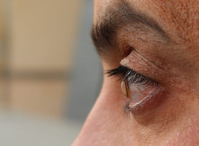 Keratoconus - Alodokter