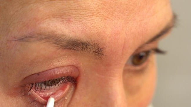 Pilihan Salep Mata Bintitan dan Cara Menggunakannya - Alodokter