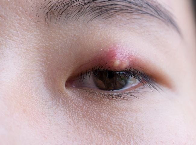 8 Obat Mata Bintitan Paling Manjur di Apotek - Alodokter