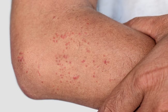 7 Penyebab Bintik Merah Gatal Menyebar - Alodokter