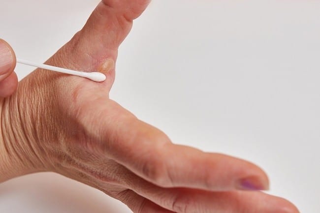 10 Obat Luka Bakar Melepuh yang Ampuh - Alodokter