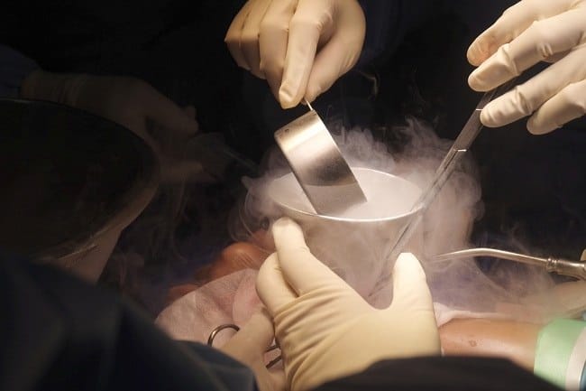 Cryosurgery, Membasmi Kanker Menggunakan Es - Alodokter