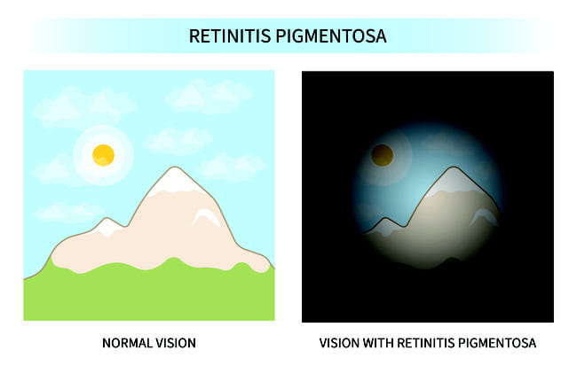 Retinitis Pigmentosa - Alodokter