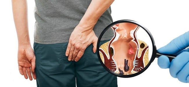 Benjolan Ambeien, Ketahui Penyebab dan Cara Menghilangkannya - Alodokter