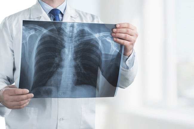 Cedera Tulang Dada, Ketahui Penyebab dan Cara Mengatasinya - Alodokter