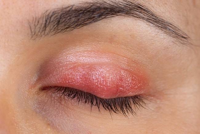 Benjolan di Kelopak Mata, Ketahui Tips Sederhana Menyembuhkannya - Alodokter