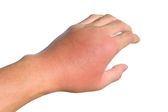 Peradangan, Kenali Mekanisme, Gejala, hingga Penanganannya - Alodokter