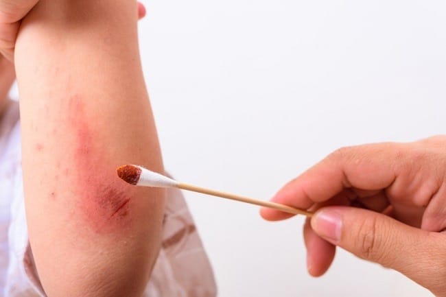 Luka di Siku Tangan, Ketahui Langkah Perawatan yang Tepat - Alodokter