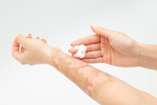 Bekas Luka Bakar, Ketahui Jenis dan Cara Menghilangkannya - Alodokter