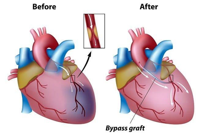 Operasi Bypass Jantung, Ini yang Harus Anda Ketahui - Alodokter