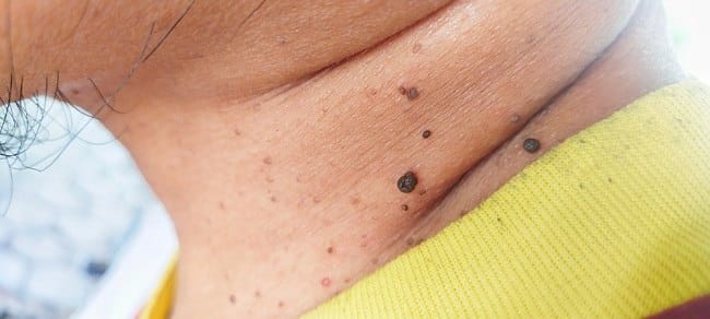 Mengenal Penyebab Kutil di Leher dan Cara Mencegahnya - Alodokter