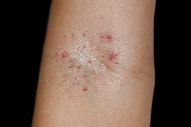 Petekie, Bintik Merah pada Kulit yang Menyerupai Ruam - Alodokter