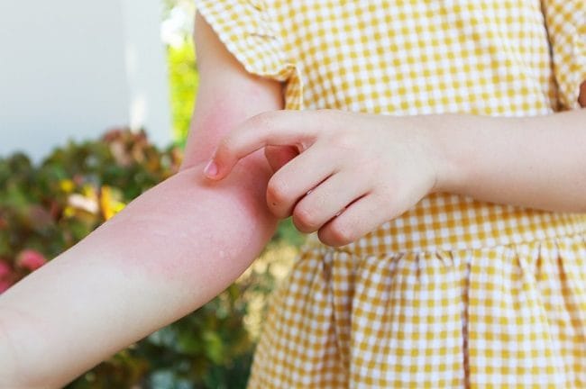 Biduran pada Anak, Kenali Penyebab dan Penangananya - Alodokter