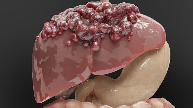 Tumor Ganas, Ketahui Penyebab, Gejala, dan Pengobatannya - Alodokter