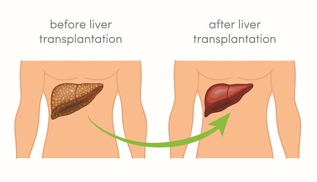 Transplantasi Hati, Ini yang Harus Anda Ketahui - Alodokter