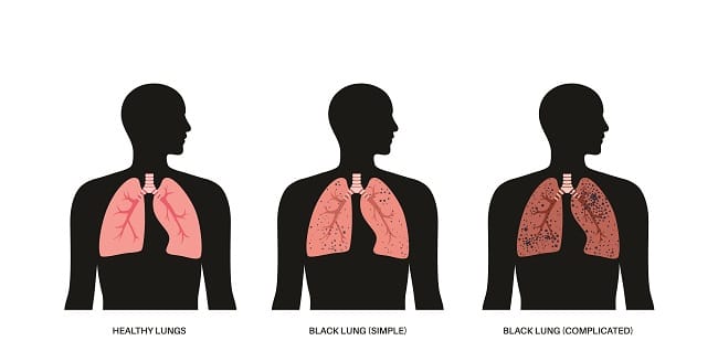 Black Lung Disease