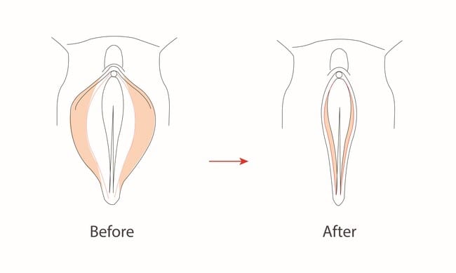Labiaplasty dan Hal-hal Penting di Dalamnya - Alodokter