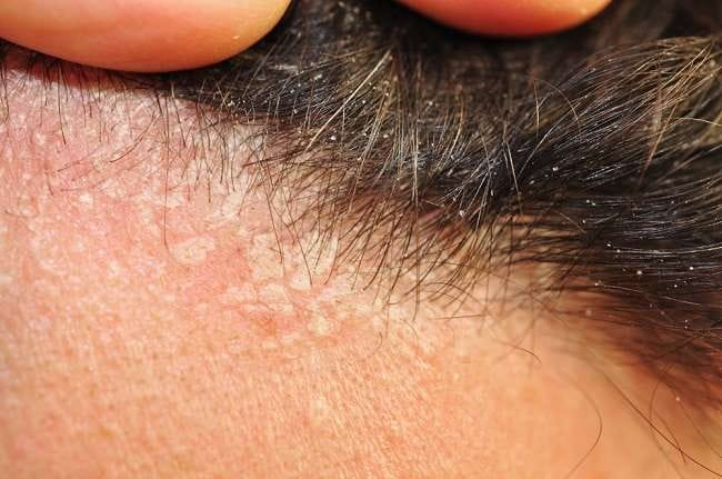 Dermatitis Seboroik Kepala, Kenali Penyebab, Gejala, dan Cara Menanganinya - Alodokter