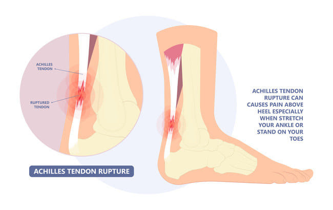 Achilles Tendon Rupture - Alodokter