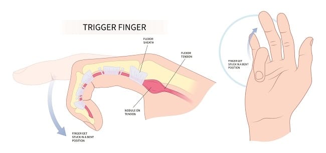 Trigger Finger - Alodokter