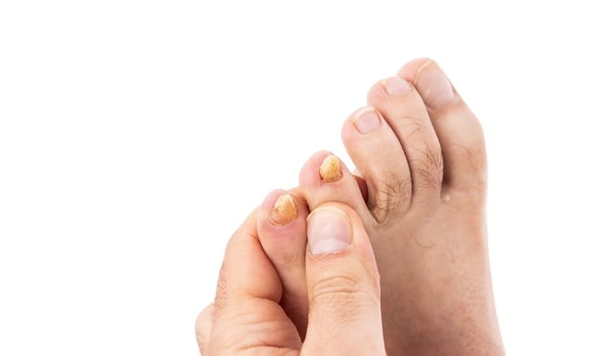 7 Obat Jamur Kuku yang Ampuh - Alodokter