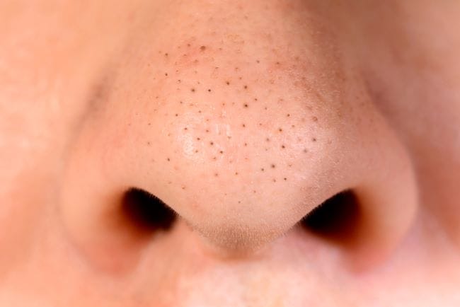 Kenali Penyebab dan Cara Mengatasi Blackhead - Alodokter